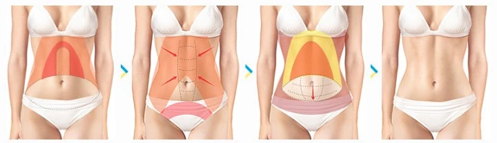 Bauchdeckenstraffung – Eine straffere und flachere Bauchpartie Plastische Chirurgie in der Türkei