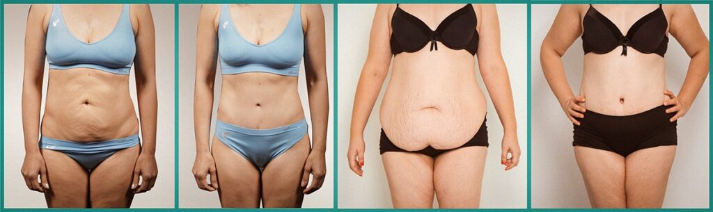 Plastische Chirurgie bzw. Schönheits-OP nach Magenverkleinerung in der Türkei 1 Bauchstraffung turkei vorher naher