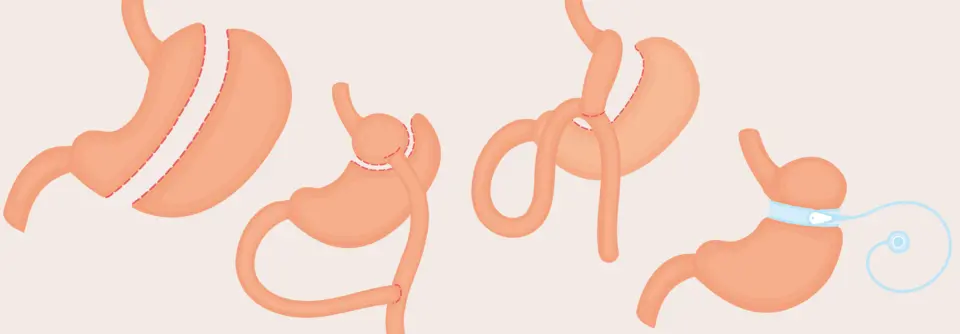 Magenverkleinerung – Effektiver Gewichtsverlust und verbesserte Gesundheit Schlauchmagen op