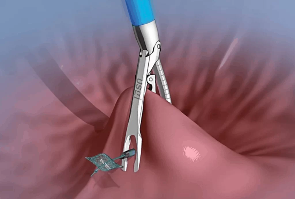 Adipositas-Chirurgie ohne Narbe – POSE-Methode narbenlose narbenfreie