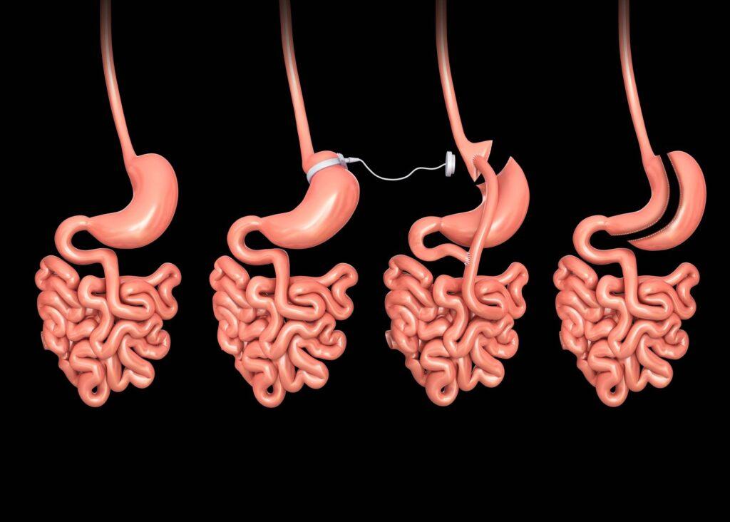 Adipositaschirurgie – Missverständnisse – Fakten vs. Mythen 
