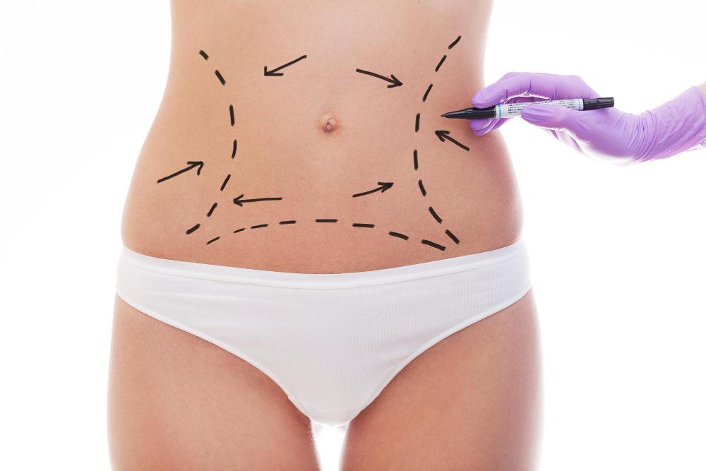 Was ist ein Bodylift türkei antalya kosten aesthetic travel