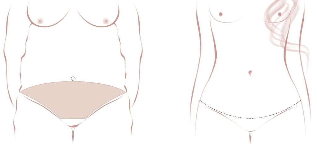 Abdominoplastik – Bauchdeckenstraffung 1 bauchdeckenstraffung vorher nachher schnittfuhrung