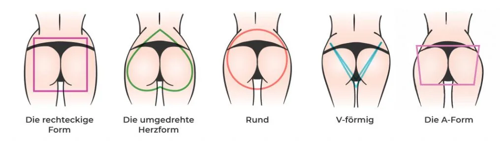Brazilian ButtLift (BBL) – Die Formung eines attraktiven Gesäßes
