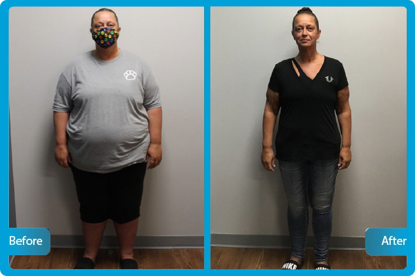 Bariatric Revision Before After