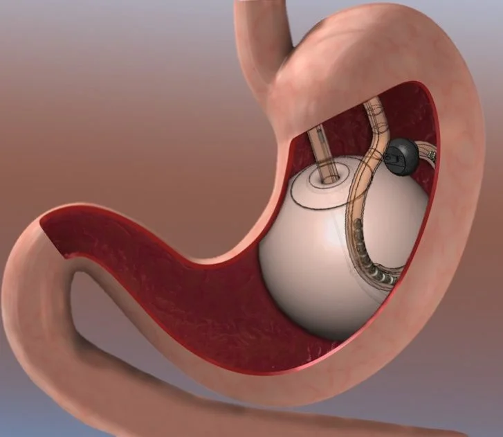 Narbenfreie Adipositas Chirurgie – Magenballon
