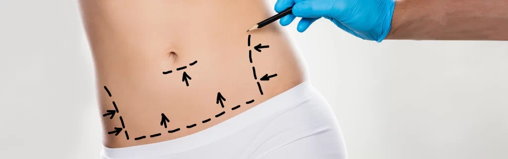 Mini-Bauchdeckenstraffung – Eine schonende Alternative für lokale Problemzonen Plastische Chirurgie in der Türkei