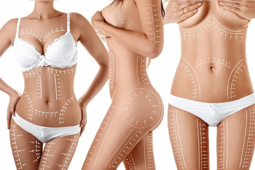 Plastische Chirurgie bzw. Schönheits-OP nach Magenverkleinerung in der Türkei 5 mommy makeover turkei antalya istanbul kosten