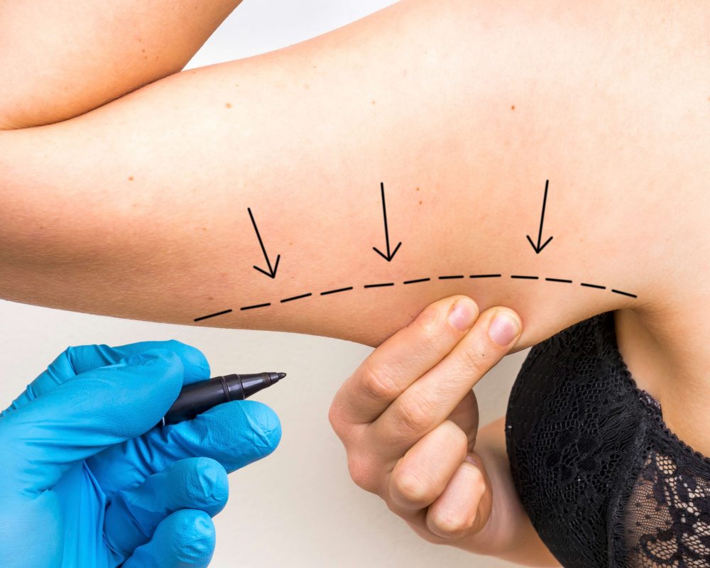 Plastische Chirurgie bzw. Schönheits-OP nach Magenverkleinerung in der Türkei 3 oberarmstraffung armstraffung turkei antalya kosten